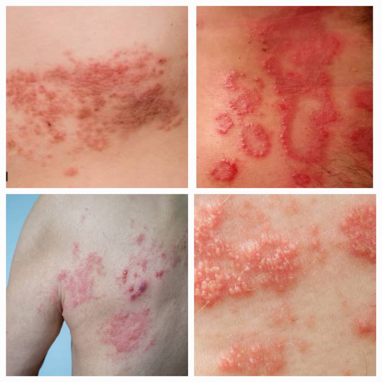 HERPES ZOSTER - नागीण आजार