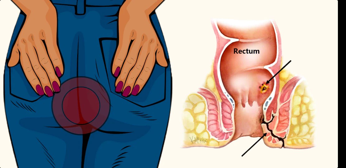 FISTULA - फिस्टुला