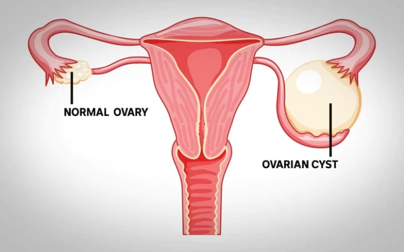 GYNAECOLOGY