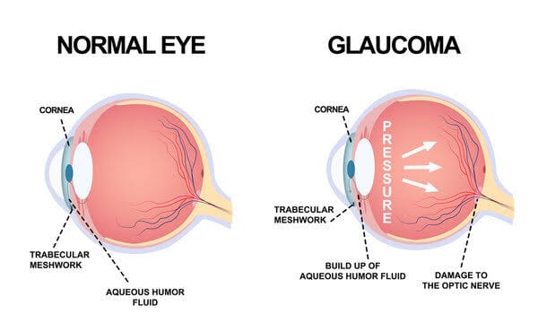 काचबिंदु  (GLAUCOMA - The Silent Killer of the Eye)