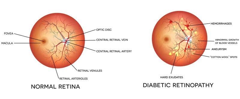 डायबेटीक रेटीनो पॅथी (DIABETIC RETINOPATHY)