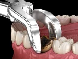 PAINLESS TOOTH REMOVAL