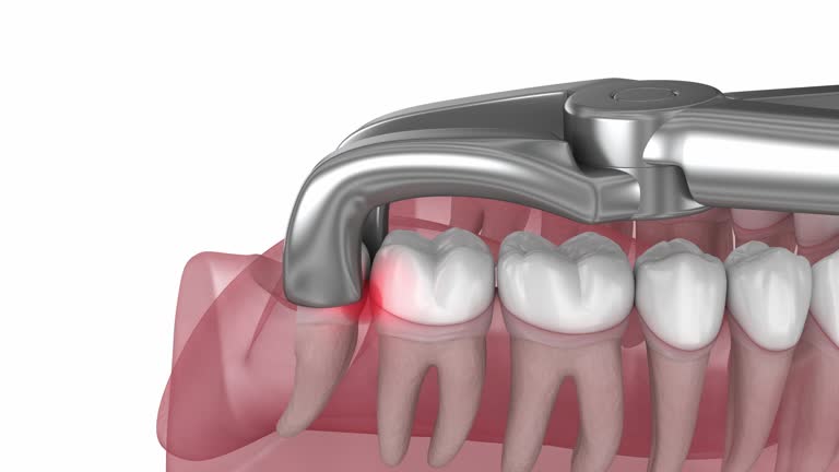 WISDOM TOOTH REMOVAL