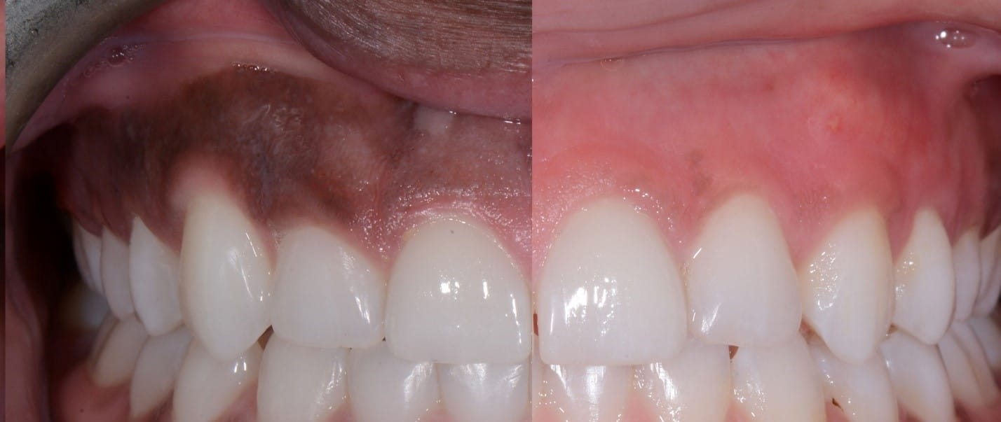GUM DEPIGMENTATION