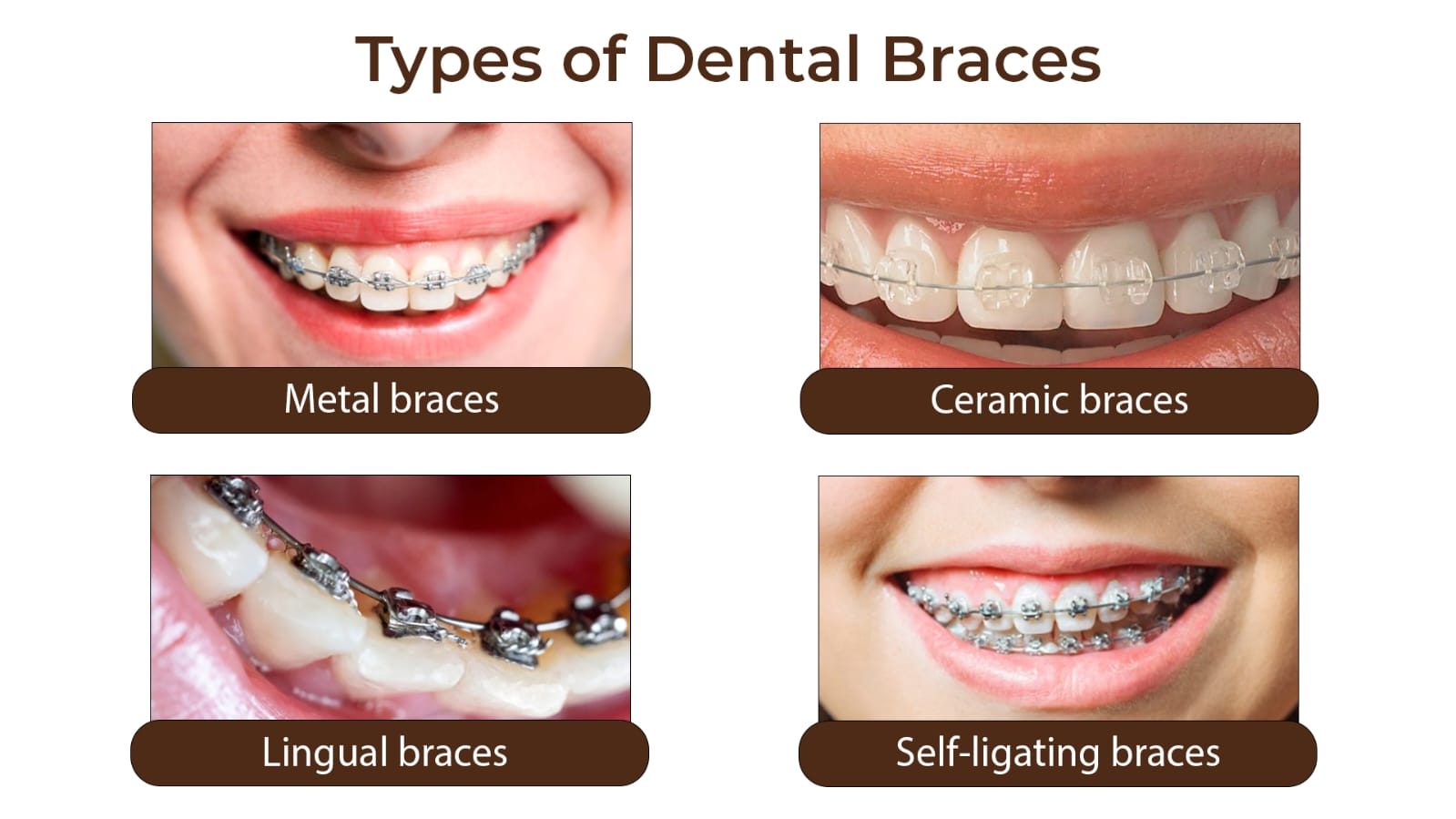 BRACES