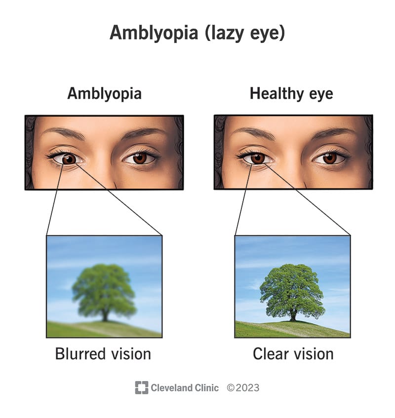 आळशी डोळा (Amblyopia)