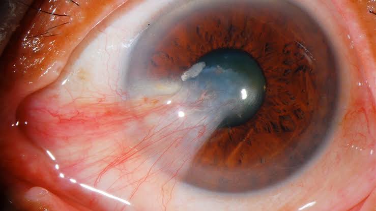 PTERYGIUM शस्त्रक्रिया