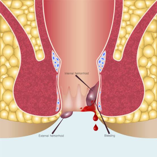 फिस्टुला (Fistula)