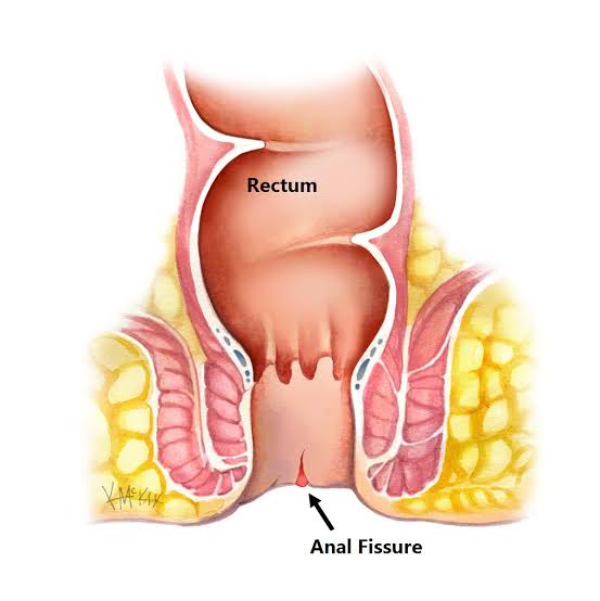 फिशर (Anal Fissure)