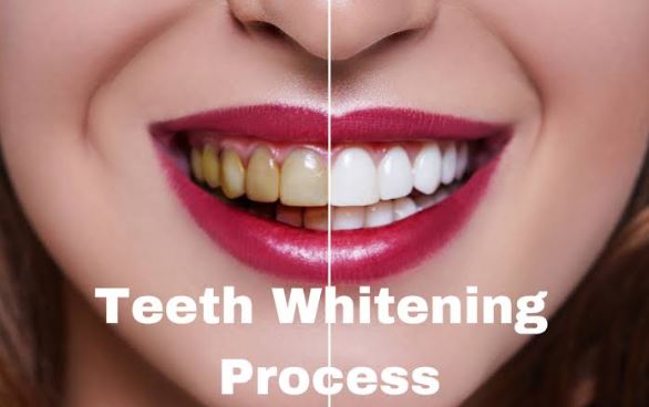 TEETH WHITENING
