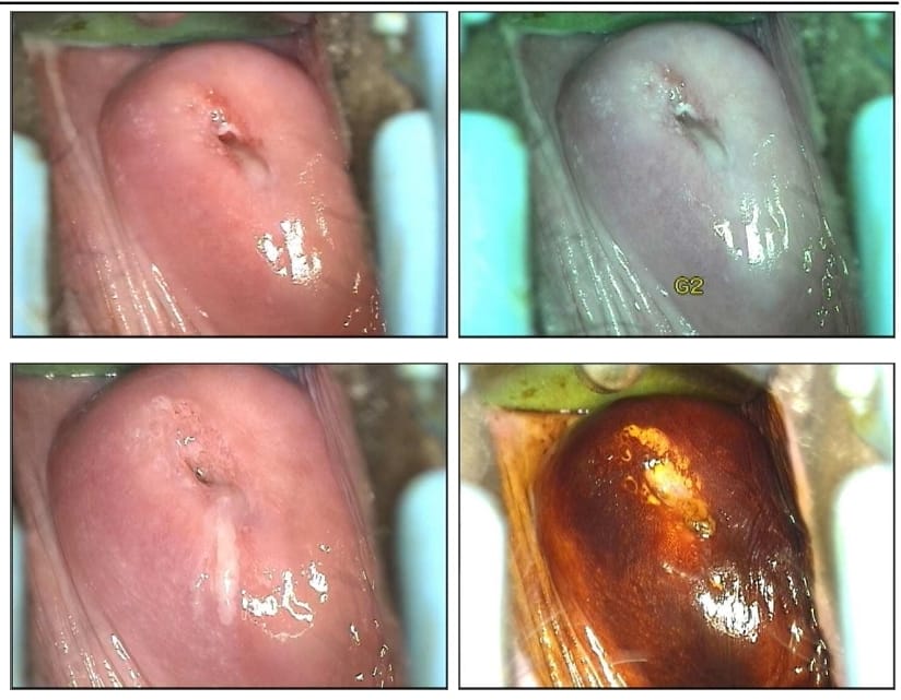 गर्भाशयाच्या मुखाची जखम उपचारा नंतर