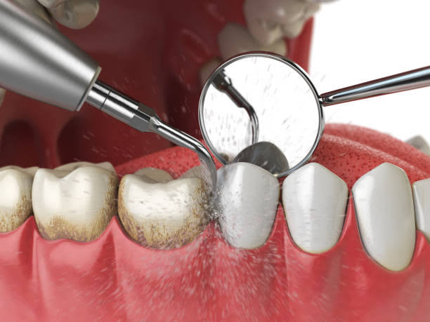 TEETH CLEANING