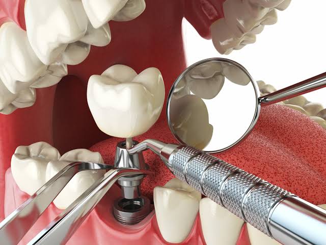 DENTAL IMPLANTS