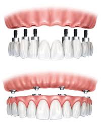 FULL MOUTH REHABILITATION