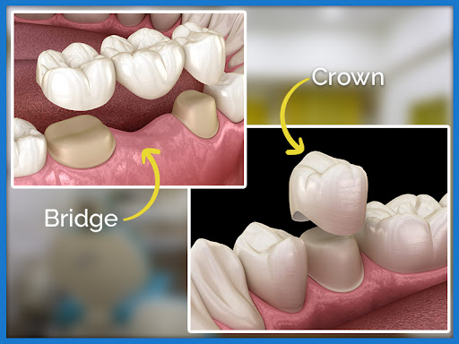 CROWNS AND BRIDGES