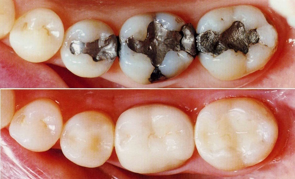 TOOTH COLOURED FILLINGS