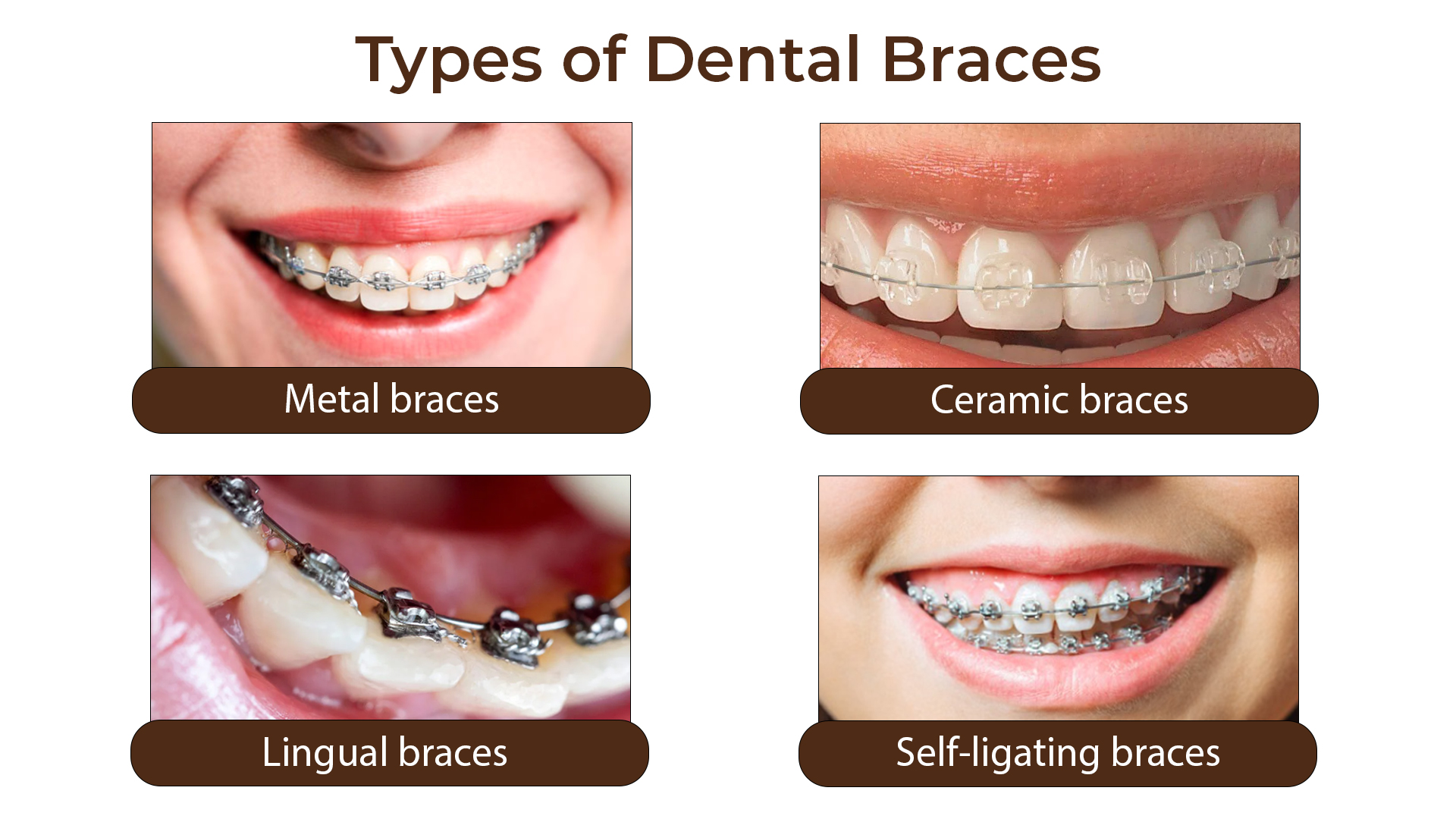 BRACES