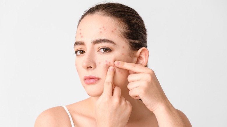 PIMPLE PROBLEM