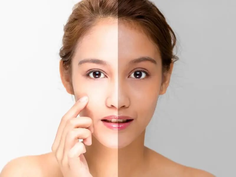 SKIN WHITENING TREATMENT