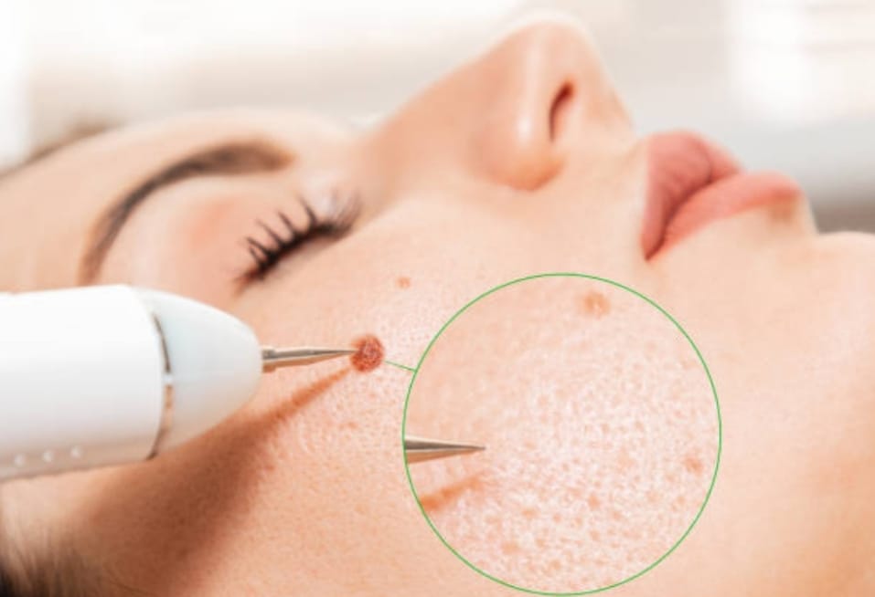 MOLE AND WART REMOVAL