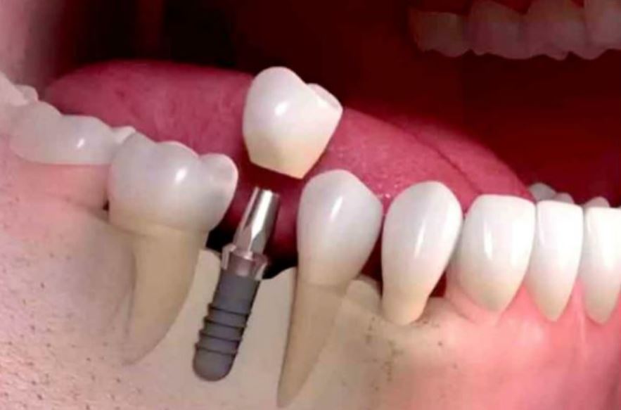 DENTAL IMPLANTS