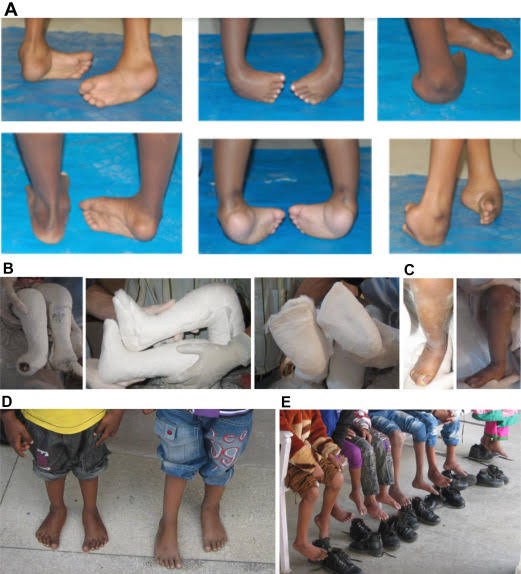 जन्मजात वाकडे पाय व जोडलेले बोटे यांवर प्लास्टर व शस्त्रक्रिया