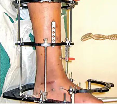 इलिझाराेव्ह शस्त्रक्रिया