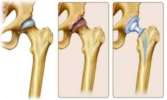 टोटल हिप रिप्लेसमेंट
