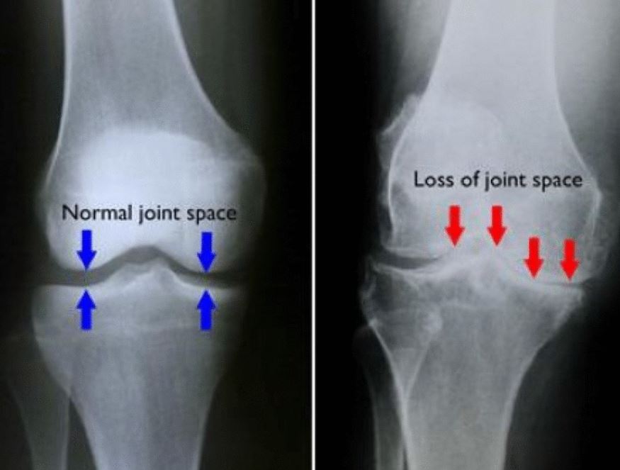 संधिवातावर उपाय
