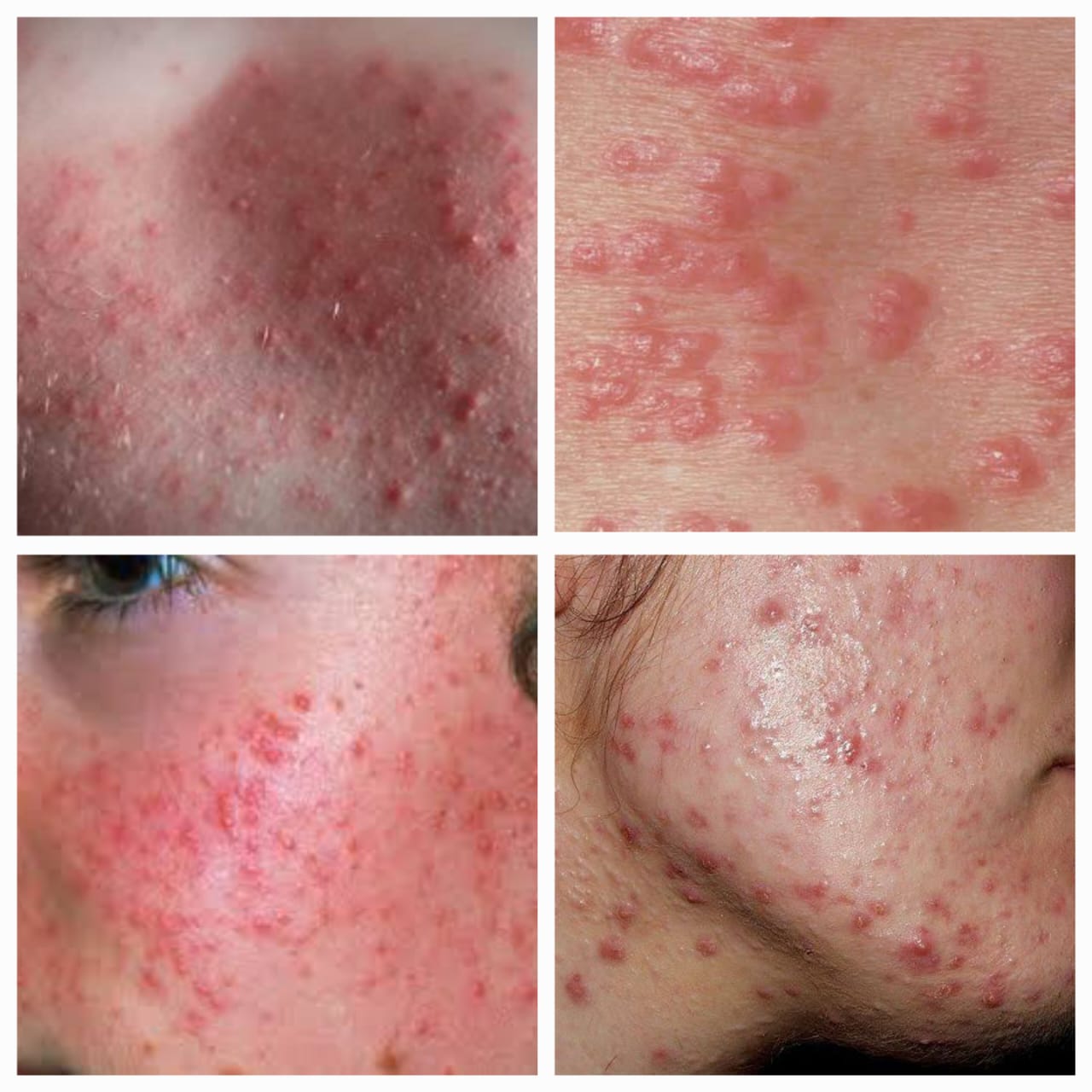 Skin Rashes - अंगावर पुरळ उठणे