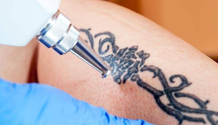 Tattoo Removal - टैटू रिमूवल