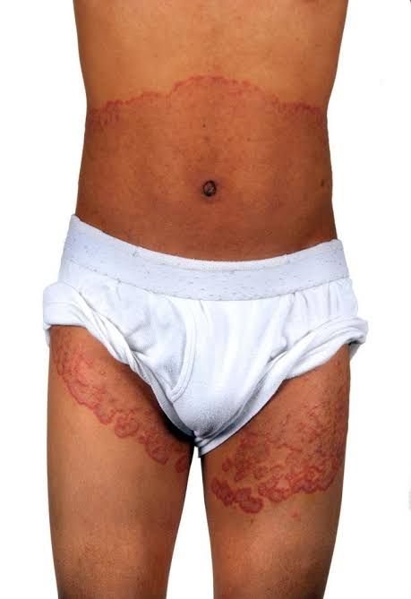 Tinea Infection - फंगल इन्फ़ेक्शन