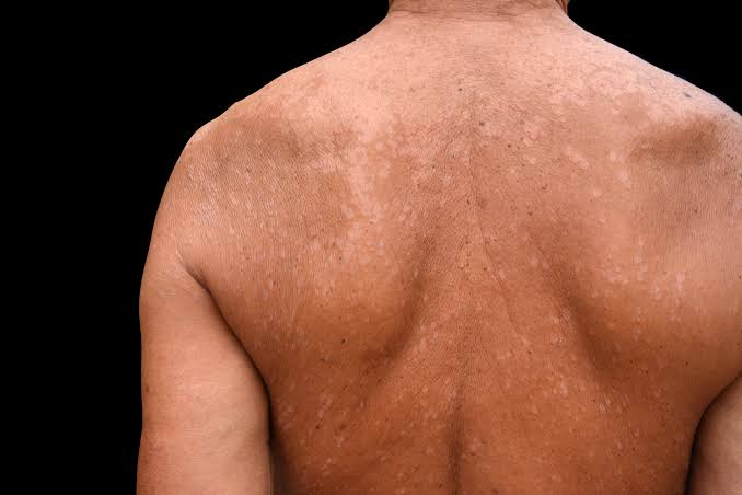 Tinea Versicolor - शेरण्या