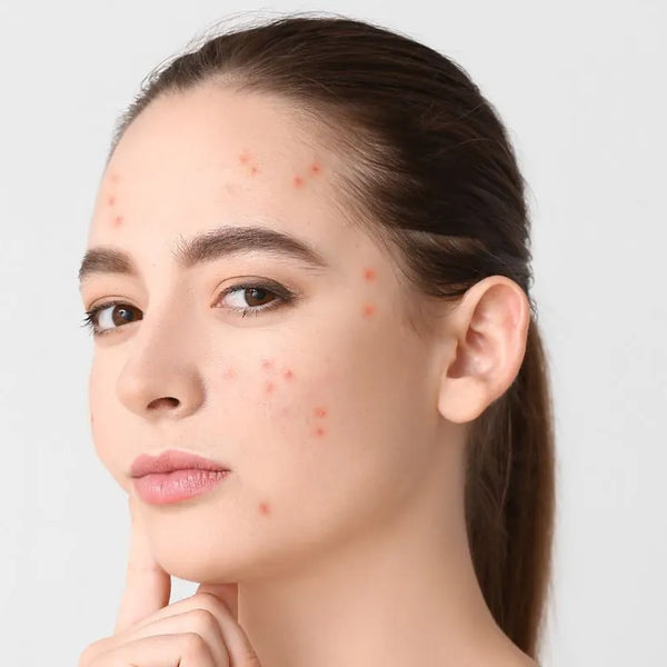 Skin diseases