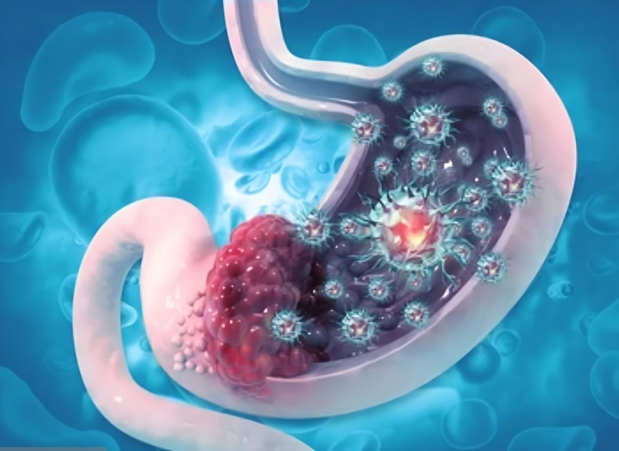 पोटाचा कॅन्सर - Stomach cancer