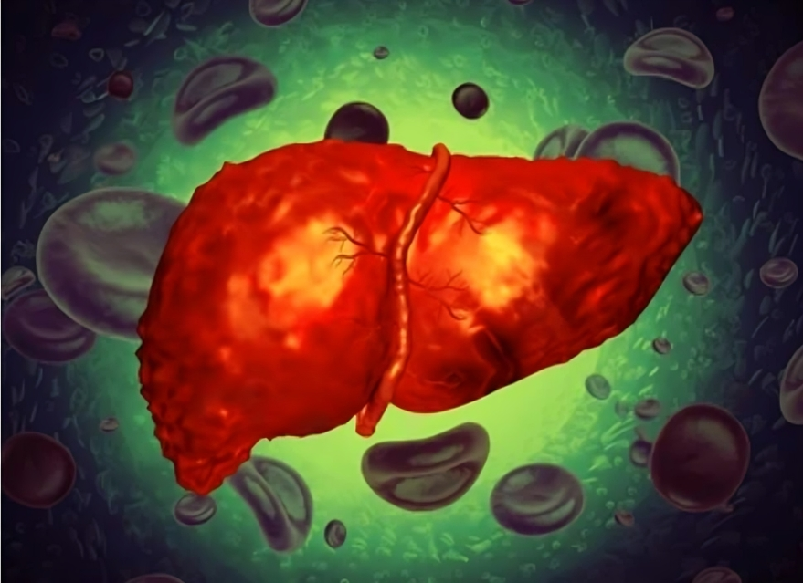 लिव्हर कॅन्सर - Liver cancer