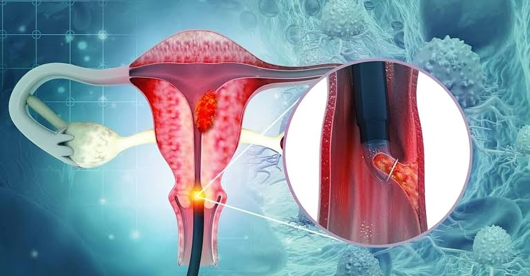 गर्भाशय मुखाचा कॅन्सर - Cervical cancer