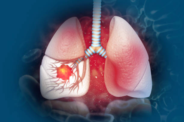 फुफ्फुसाचा कॅन्सर - Lung Cancer