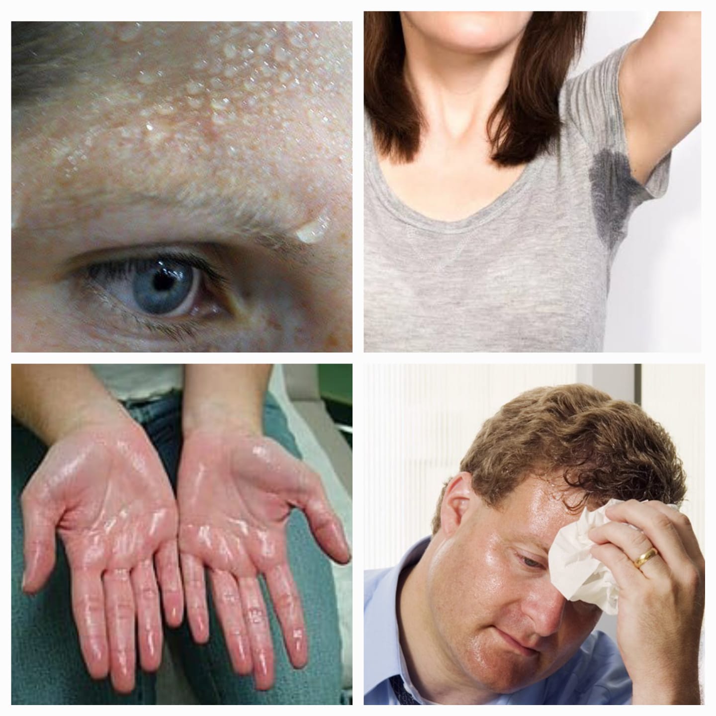 जास्त घाम येणे - Excessive sweating