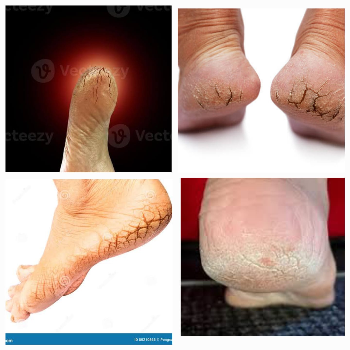 जळवात - Cracked heels