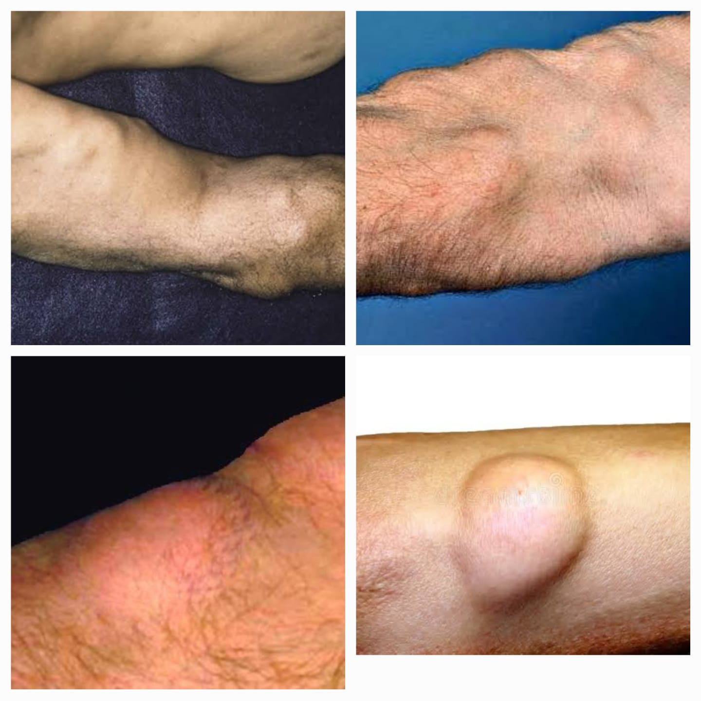 अंगावर गाठी येणे – Lipoma