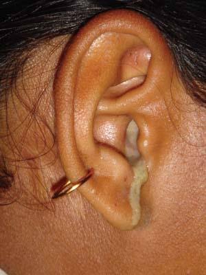 कानातून पाणी येणे – Ear Discharge