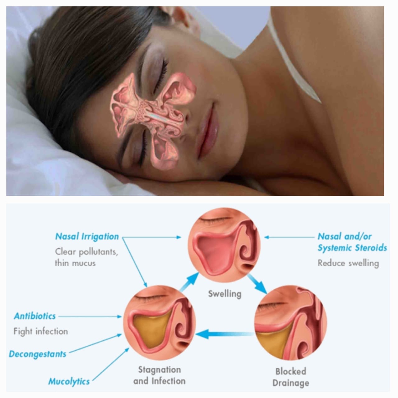 सायनस इन्फेक्शन – Sinusitis