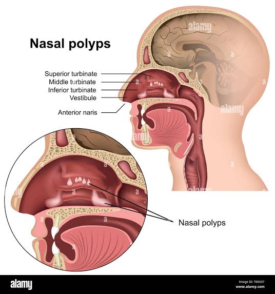 नाकात मांस वाढणे – Nasal Polyps