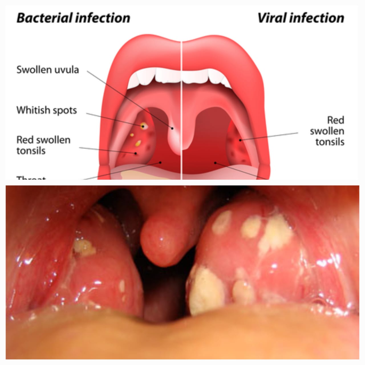 टॉन्सिल्स