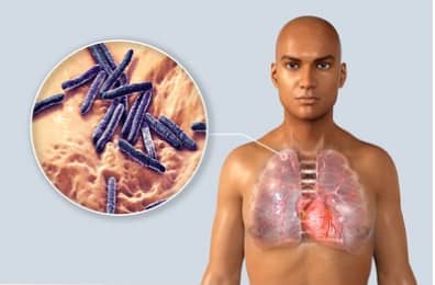 क्षयरोग – Tuberculosis