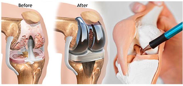 गुडघा प्रत्यारोपण शस्त्रक्रिया