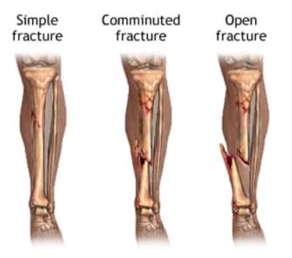 बोन फ्रॅक्चर