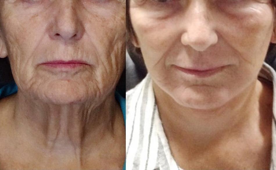 चेहर्यावरील प्लास्टिक शस्त्रक्रिया (Facial Plastic Surgery)