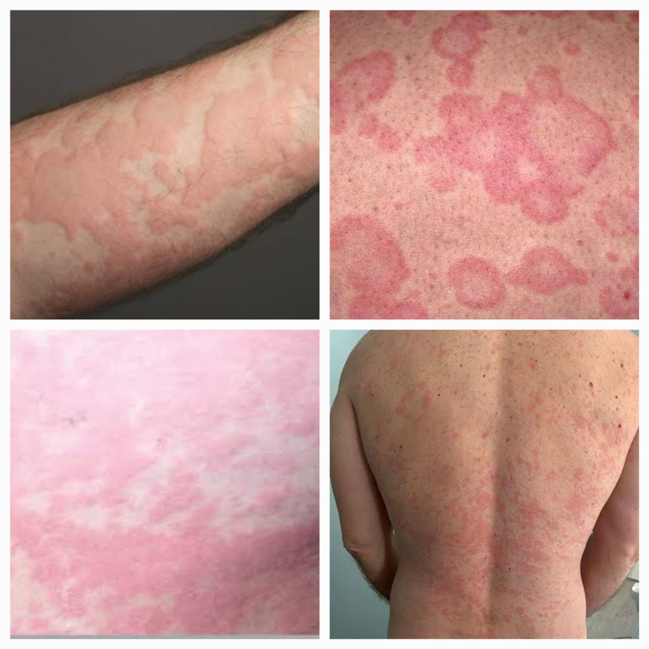 अंगावर पित्त उठणे - Urticaria